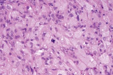 Fig. 12, Atypical fibroxanthoma with granular cell change.