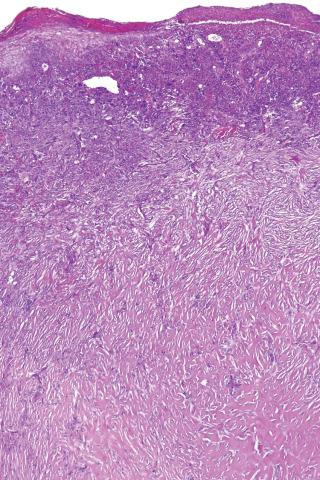 Fig. 13, Atypical fibroxanthoma with keloidal areas.