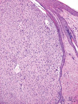 Fig. 15, Atypical fibroxanthoma