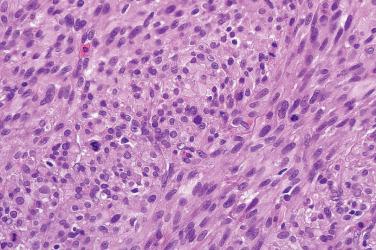 Fig. 16, Atypical fibroxanthoma