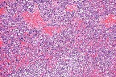 Fig. 17, Atypical fibroxanthoma