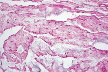 Fig. 5, Superficial angiomyxoma,