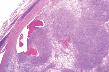 Fig. 1, Angiomatoid fibrous histiocytoma.