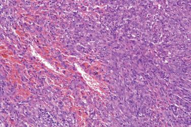 Fig. 4, Angiomatoid fibrous histiocytoma.