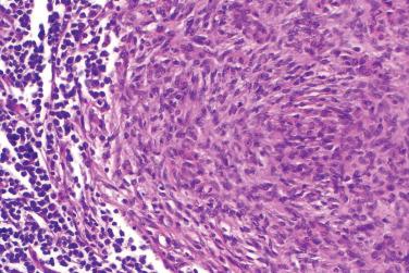 Fig. 5, Angiomatoid fibrous histiocytoma.