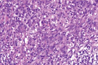 Fig. 6, Angiomatoid fibrous histiocytoma.