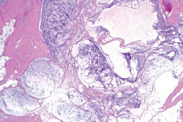 Fig. 1, Intramuscular myxoma.