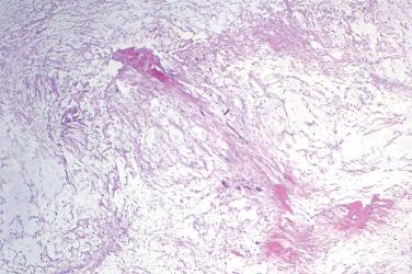 Fig. 2, Intramuscular myxoma.