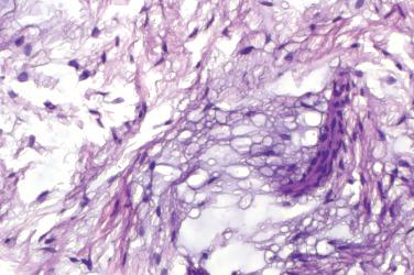 Fig. 5, Intramuscular myxoma.