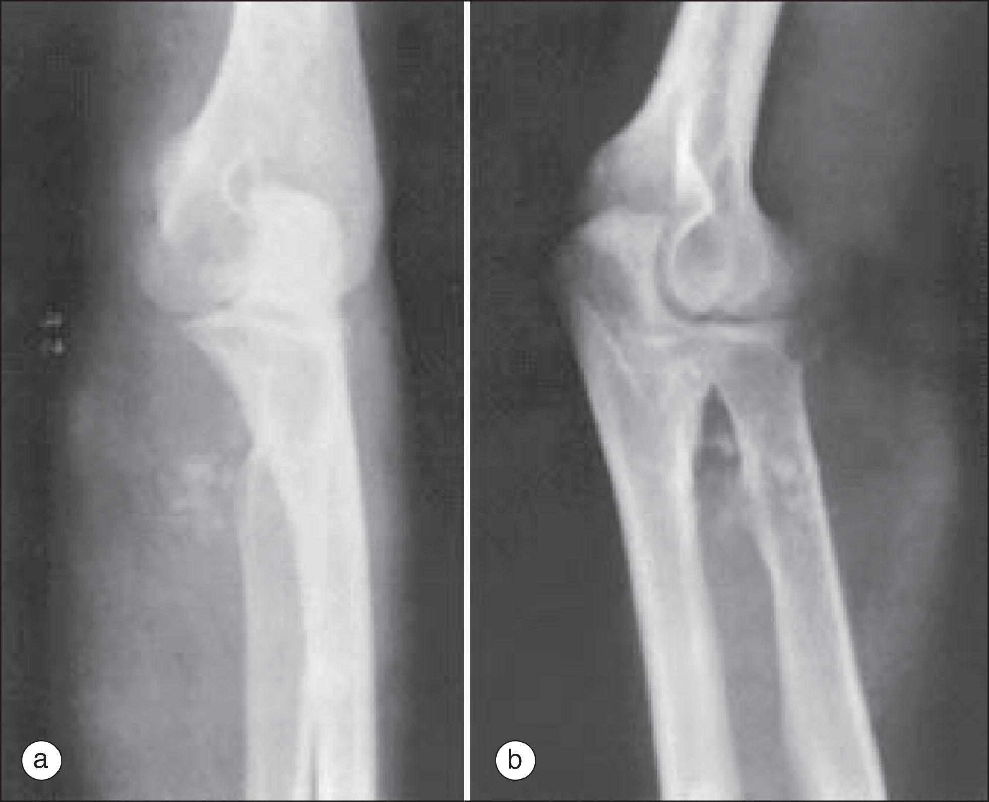 Fig. 215.1, (a) and (b) Synovial sarcoma near, but not involving, the elbow joint. Note ossification and calcification in tumor.