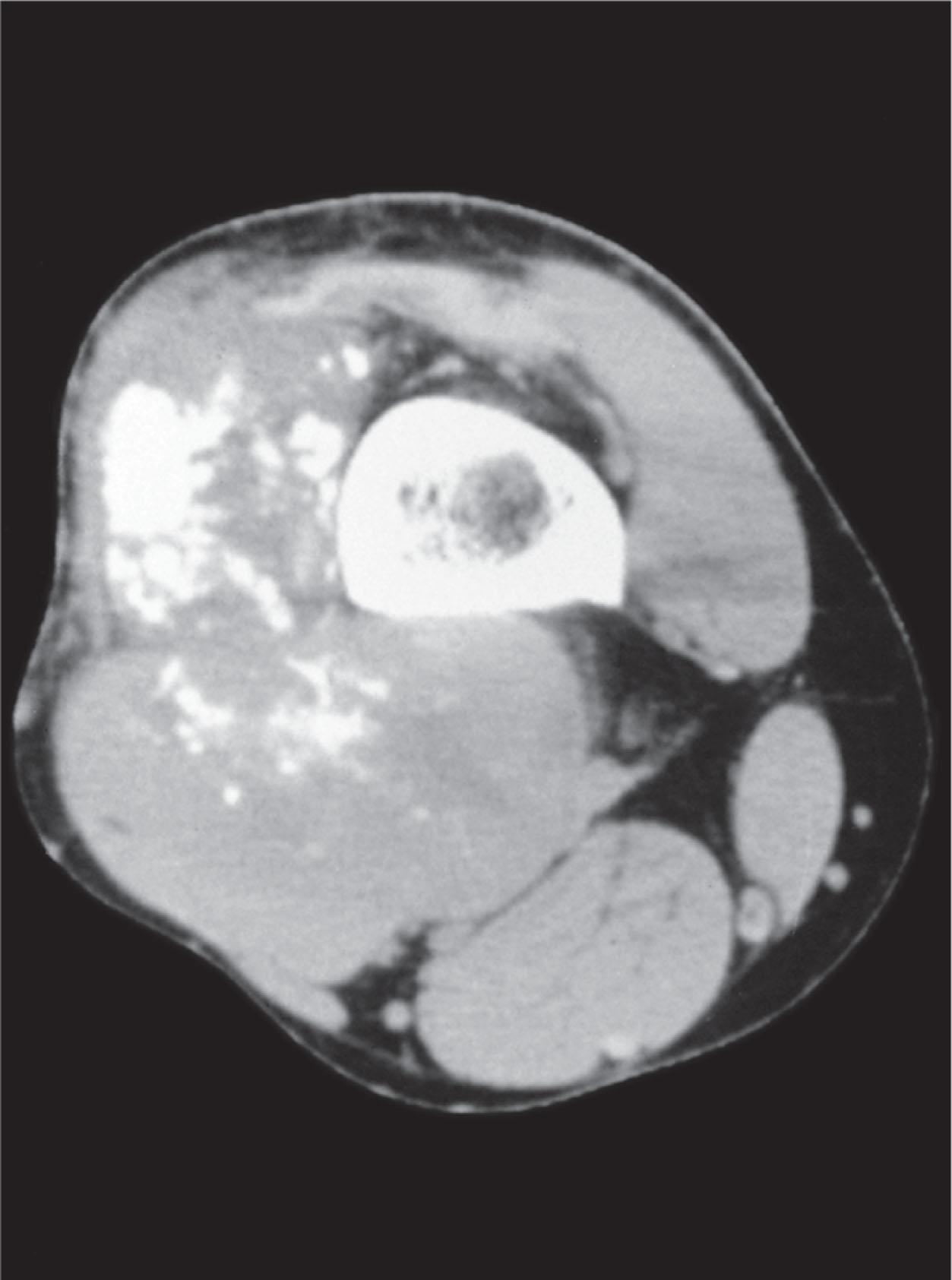 Fig. 215.2, Synovial sarcoma. Axial computed tomography scan demonstrating a soft tissue mass lateral and posterior to the femur containing calcifications.