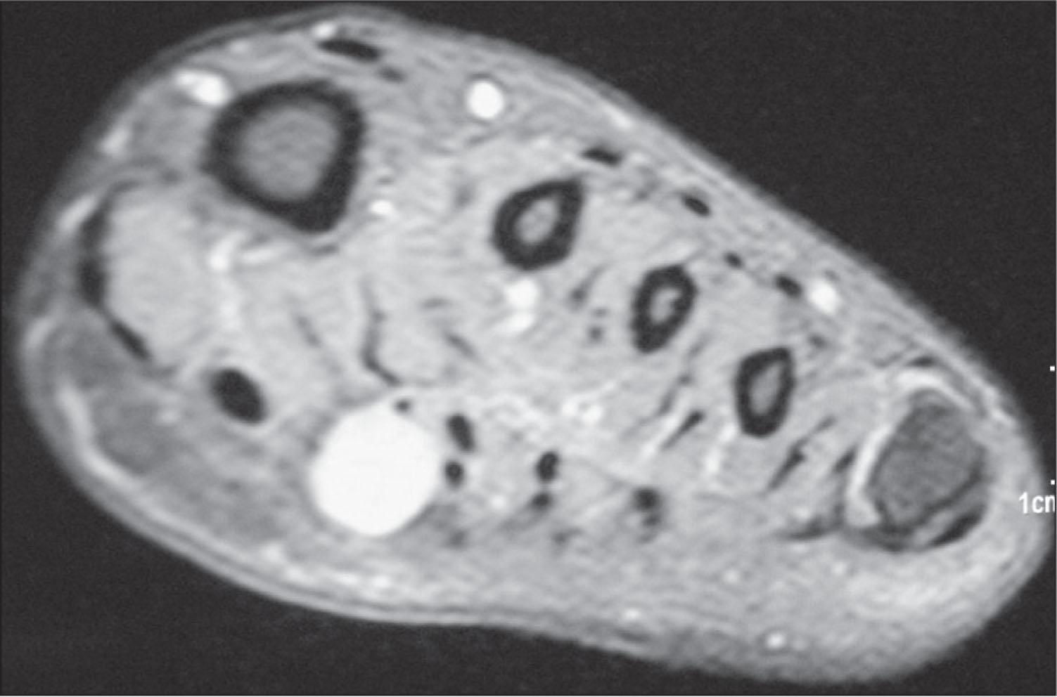 Fig. 215.3, Axial, T2-weighted, fat saturation image of the foot demonstrating a small synovial sarcoma.