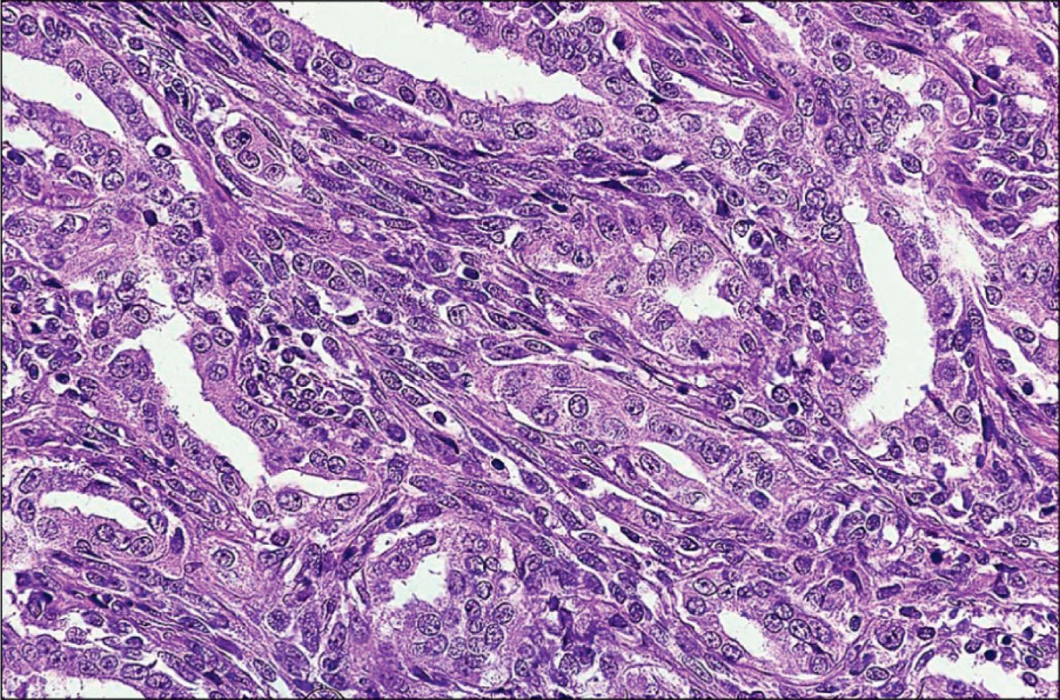 Fig. 215.4, Typical biphasic appearance of synovial sarcoma.