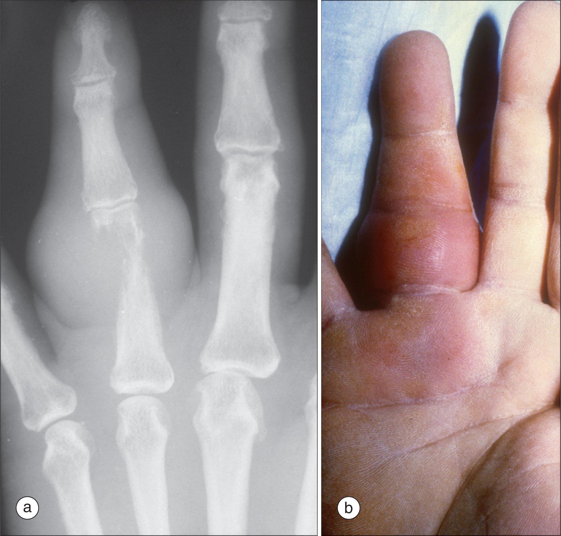 Fig. 215.5, (a) Radiograph of the digit of a patient with metastatic lung cancer shows destructive changes. (b) Inflammatory appearance of the same finger.