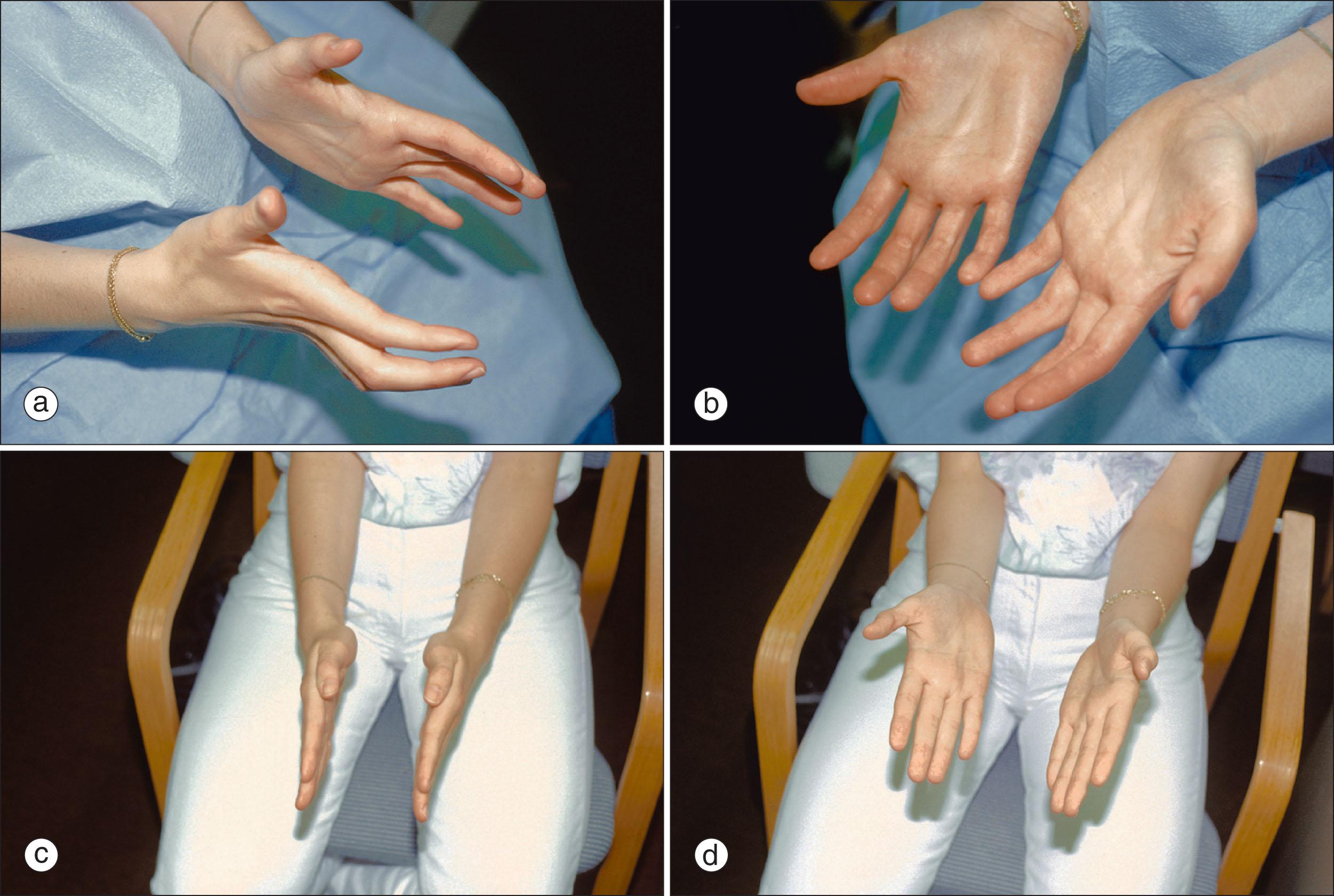 Fig. 215.6, Palmar fasciitis. (a) and (b) Two views of the hands of a patient with palmar fasciitis secondary to a nonmalignant ovarian cyst. (c) and (d) Two views of the hands of the same patient after removal of the ovarian cyst demonstrating resolution of the findings.