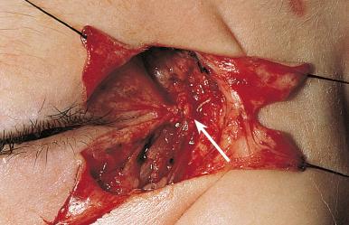 Fig. 18.1f, Medial canthal tendon reattached.