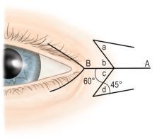 Diag. 18.1a, Mustardé double Z -plasty.