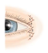 Diag. 18.1b, Z-plasty flaps transposed and wound closed.