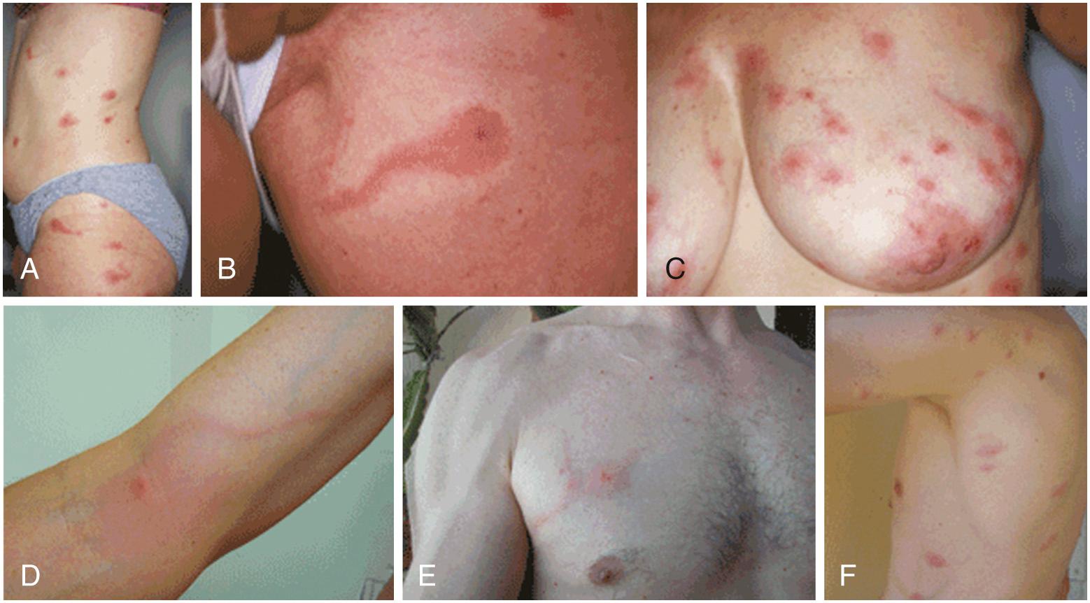 FIG. 295.6, (A–F) Photographs of six persons with skin lesions of Pyemotes ventricosus dermatitis.