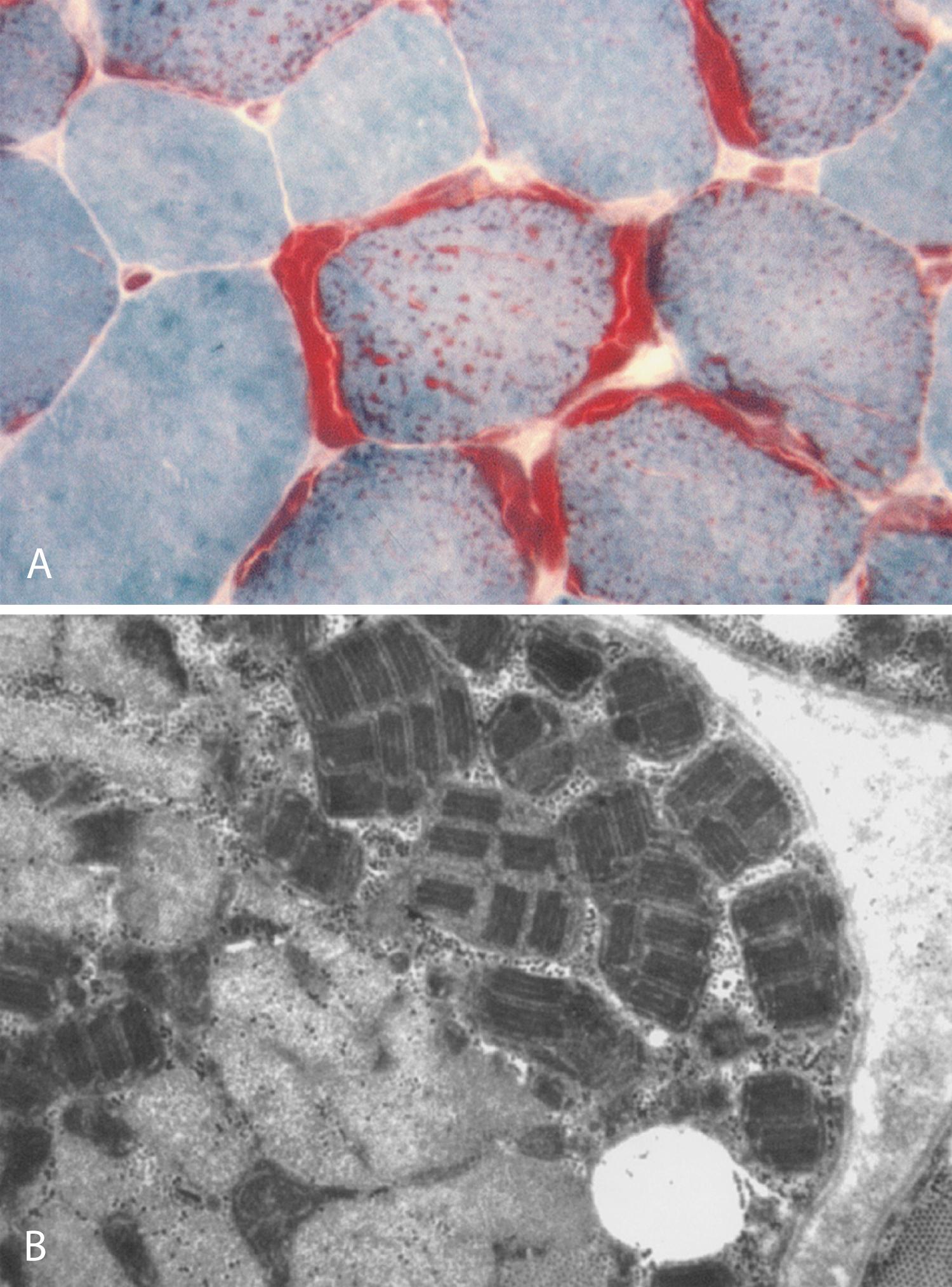 Fig. 93.2, A , Modified Gomori trichrome section of a biopsy showing ragged-red muscle fibers. Increased mitochondrial staining in the subsarcolemmal and intermyofibrillar regions of the muscle fibers imparts the ragged-red appearance. B , Mitochondrial myopathy. Electron micrograph of a part of the muscle fiber showing mitochondrial proliferation; many mitochondria contain typical “parking lot” paracrystalline inclusions.