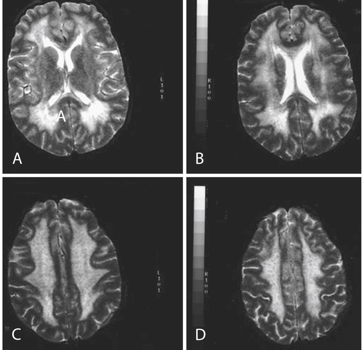 Fig. 93.3, Mitochondrial Neurogastrointestinal Syndrome.