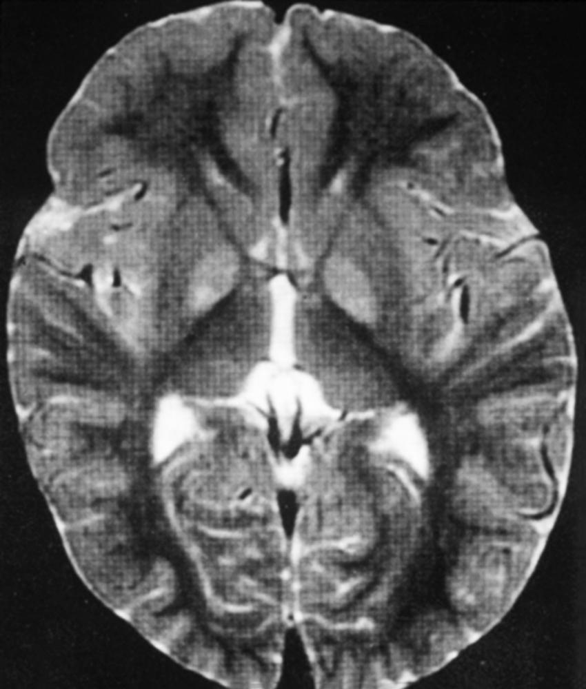 Fig. 93.5, Leigh Syndrome.