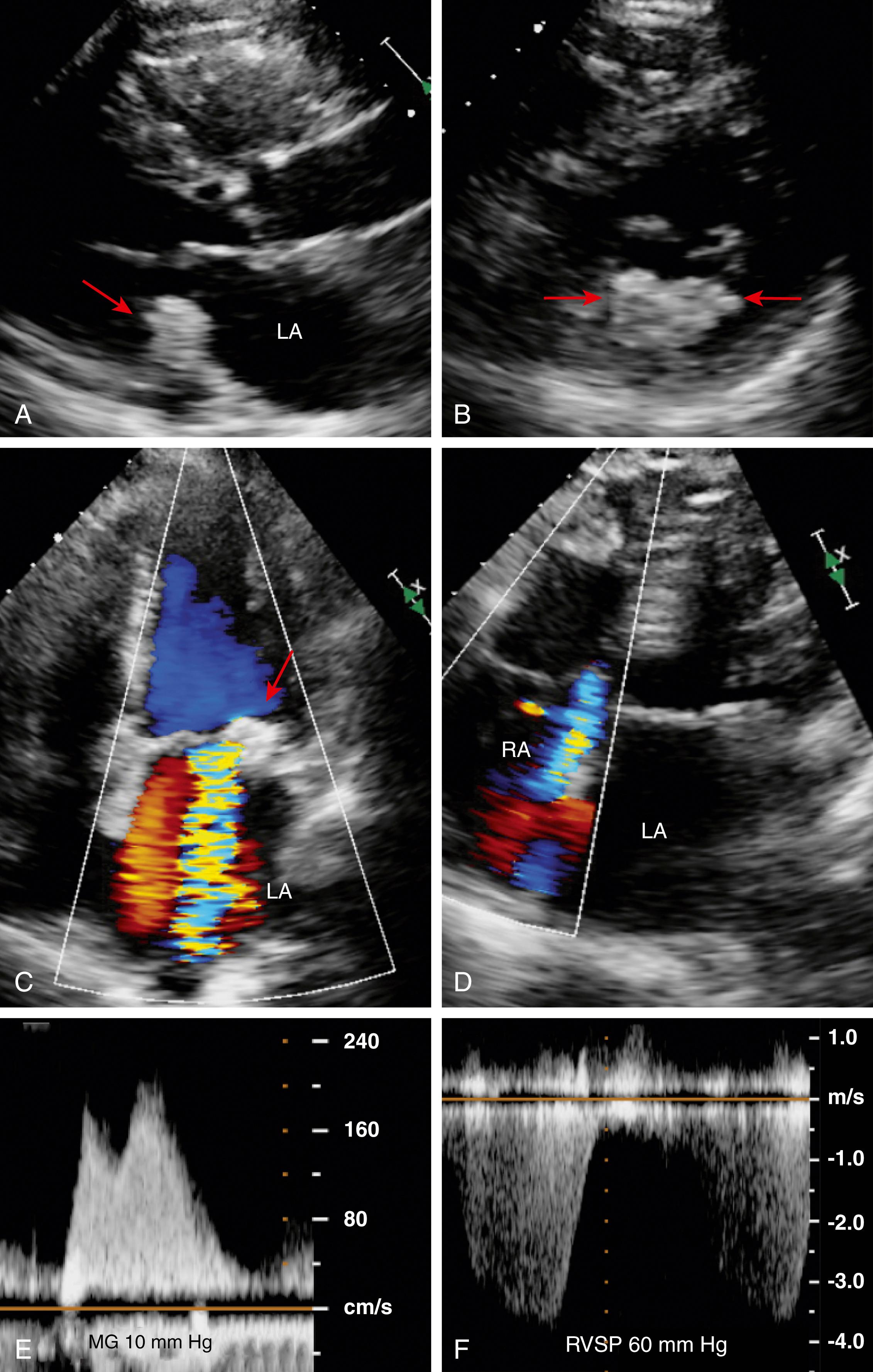 Figure 165.1, Degenerative or calcific mitral stenosis. A, Parasternal long-axis view of the left ventricle (LV) with severe calcification of the mitral annulus (red arrow) . Note the enlarged left atrium. B, Parasternal short-axis of the LV. Note the dense and extensive calcification of the posterior mitral annulus (red arrows). C, Apical four-chamber view illustrates the dense calcification of the mitral anulus (red arrow) and the presence of associated moderate mitral regurgitation. D, Another apical four-chamber view illustrates the presence of associated tricuspid regurgitation. E, The presence of a mean transmitral gradient of 10 mm Hg is noted, and the associated pulmonary hypertension is documented F . RA, Right atrium; RVSP, right ventricular systolic pressure.