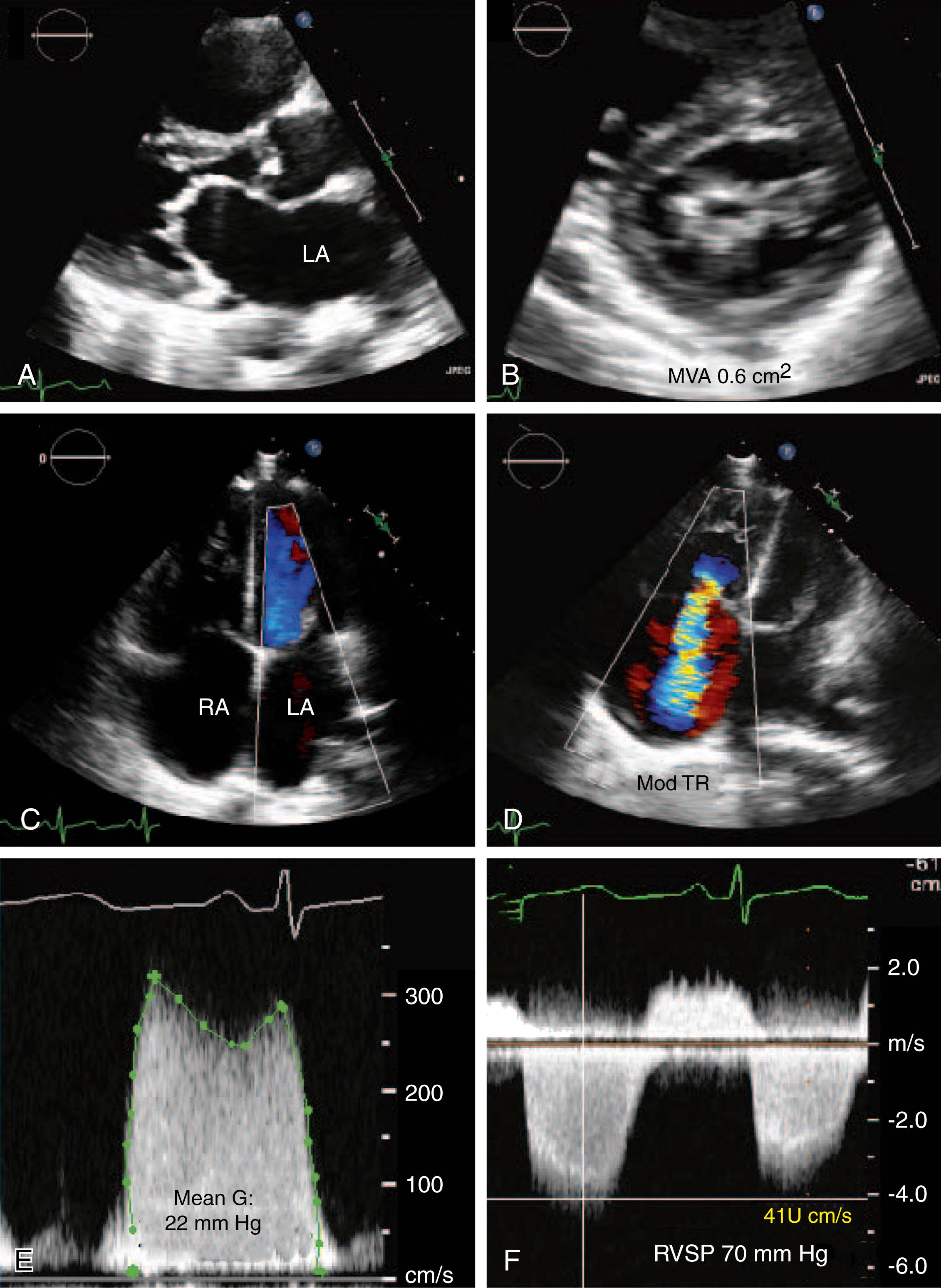 Figure 165.2, Rheumatic mitral stenosis (MS) severity. A 22-year-old woman with rheumatic heart disease, including tricuspid regurgitation, mitral stenosis, and mixed aortic valve disease with resultant pulmonary hypertension, who presented with decompensated heart failure and atrial fibrillation. A, Left parasternal view of the mitral valve shows the typical doming and funnel-shaped mitral valve with an associated large left atrium (LA). The Wilkins score was measured at 8. B, Parasternal short-axis view of the mitral valve demonstrates bicommissural fusion and a very small mitral orifice size with a mitral valve area (MVA) of 0.6 cm 2 by planimetry. C, Color Doppler apical four-chamber view demonstrates absence of mitral regurgitation. D, Moderate (Mod) tricuspid regurgitation (TR). E, Apical Doppler transmitral mean gradient of 22 mm Hg consistent with severe MS. F, Severe pulmonary hypertension as demonstrated by the TR-derived right ventricular systolic pressure (RVSP) of 70 mm Hg. G, Gradient; RA, right atrium.