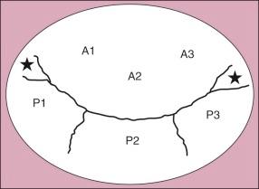 Figure 11-1, Segmental leaflet anatomy of mitral valve. Anterior leaflet has three sectors: A 1 , nearest the anterolateral commissure (labeled by star on left side of diagram); A 2 , in the mid-leaflet; and A 3 , nearest the posteromedial commissure (right-side star) . Corresponding sectors of posterior leaflet are P 1 , P 2 , and P 3 .