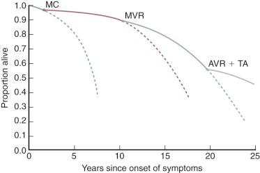 Figure 11-4, Schematic representation of life history and survival after initial development of symptoms in a large group of patients with mitral stenosis. Solid circles indicate a surgical procedure. Dashed lines represent estimated survival of patients not receiving the surgical procedure. Key: AVR, Aortic valve replacement; MC, mitral commissurotomy; MVR, mitral valve replacement; TA, tricuspid anuloplasty.