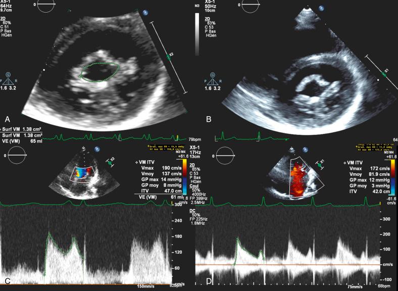 Fig. 51.1, Echocardiographic assessment of a good result of percutaneous mitral commissurotomy (PMC).
