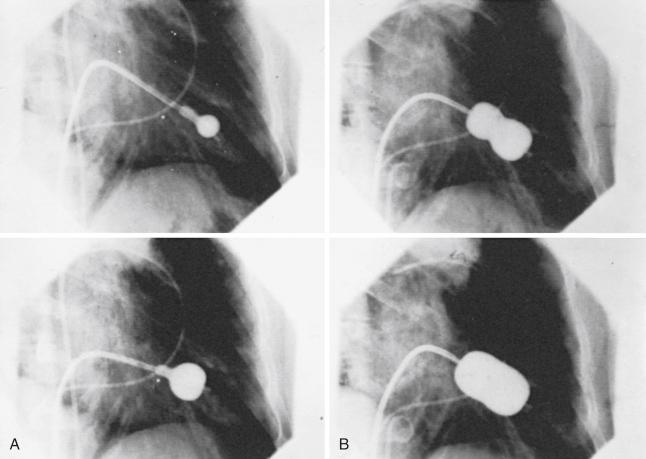 Fig. 53.2, Inoue’s percutaneous mitral commissurotomy technique.