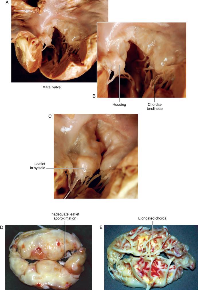 Figure 32-1, A Myxomatous degeneration of the mitral valve, autopsy specimen. Leaflets are of variable thickness but are generally thin, with typical “hoods” or bulging. B Myxomatous degeneration of the mitral valve, magnified. Hooding of leaflet tissue is seen clearly. Chordae tendineae are thin and of normal length in this specimen, but they may be elongated or ruptured. C Myxomatous degeneration of the mitral valve, showing the leaflet position in systole. An irregular coaptation surface at multiple locations causes valve regurgitation. D Severe myxomatous degeneration of a surgically excised mitral valve specimen, showing the atrial surface. A reconstructive operation is not feasible due to the extent of disease, extensive hooding, and inadequate approximation of valve leaflets in more than one area. E Severe myxomatous degeneration of a surgically excised mitral valve, showing the ventricular surface. Note the thick and thin chordae, elongation, and rupture of chordae tendineae.