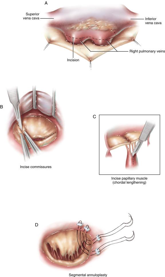 Figure 32-2, A The incision is made in the left atrium just posterior to the interatrial groove on the right side. The space between the right inferior pulmonary vein and the inferior vena cava is opened to allow extension of the incision posterior to the vena cava. The decision to perform a superior incision must be weighed carefully against the risk of possible abnormal rhythm after operation. B In patients with mitral valve stenosis caused by commissural fusion and with reasonably normal subvalvular supporting structures, the commissures of the mitral valve can be divided to relieve the stenosis. The anterior leaflet of the mitral valve must be mobile and long enough to approximate the posterior leaflet. Reasonable mobility and adequate length of the posterior leaflet are also required. The atrial septum is retracted anteriorly to expose the mitral valve. A forceps is used to grasp the anterior and posterior leaflets of the mitral valve opposite the fused commissure. A No. 15 scalpel is used to accurately incise the commissure. A forceps is then used to position the commissure and, with traction, assist in teasing the commissure open accurately. Incision of the mitral valve commissure should be anatomic and as close to the mitral valve annulus as possible without exceeding the anatomic limits of the commissure. C If necessary, the chordae tendineae and papillary muscles of the mitral valve can be lengthened somewhat by incising the papillary muscle precisely between the chordae tendineae. D When redundant leaflet tissue appears to be located in a segment of the mitral valve adjacent to a commissure, the mitral valve annulus can be narrowed by placing interrupted pledget-reinforced mattress stitches through the annulus at the commissure and drawing the redundant valve tissue into the mattress stitch at the annulus. This repair is the least controllable and least symmetric and must be done judiciously. In all cases mitral valve competence should be tested by distending the ventricle with isotonic electrolyte solution using a Robinson catheter placed through the valve. This demonstrates any areas of residual leakage, which can be repaired with additional sutures.