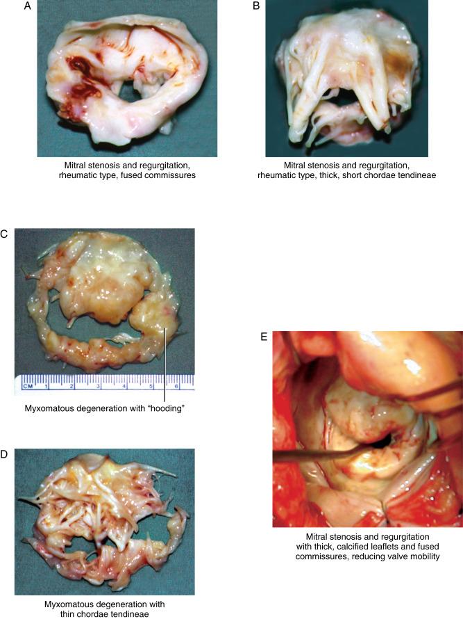 Figure 33-1, A Operative specimen of rheumatic-type mitral valve stenosis and regurgitation. The leaflets are thick, and the commissures are fused. There is inadequate leaflet tissue to close the mitral orifice. B Operative specimen of rheumatic-type mitral valve stenosis and regurgitation, viewed from the ventricular aspect to demonstrate leaflet supporting structures. Chordae tendineae are markedly thickened and shortened. C Operative specimen of mitral valve regurgitation due to severe myxomatous degeneration. The specimen shows marked “hooding” of leaflet tissue and inadequate leaflet tissue to close the mitral orifice. D Operative specimen of mitral valve regurgitation due to severe myxomatous degeneration, viewed from the ventricular aspect to demonstrate leaflet support. Chordae tendineae are thinned and degenerated, with no uniformity. Such chordae would not likely support a valve repair for very long. E Operative photograph of rheumatic-type mitral valve stenosis and regurgitation. The mitral leaflets are scarred, thickened, and calcified; the commissures are fused. Repair of this type of valve would not restore leaflet flexibility and mobility to provide adequate hemodynamic performance.