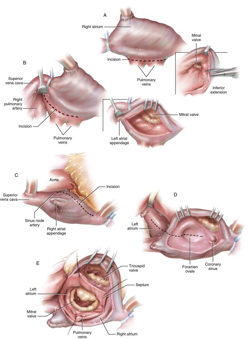 Figure 33-2, A Inferior approach. This incision is the most common method of exposing the mitral valve and can be considered standard. An incision is made in the left atrium just behind and parallel to the interatrial groove on the right side. The pericardial reflection over the inferior vena cava is opened to allow access to the posterior wall of the left atrium. The incision is extended posteriorly behind the inferior vena cava. This incision provides adequate access to the mitral valve in most situations. B Superior approach. The superior vena cava is mobilized to provide access to the roof of the left atrium. An incision is made in the left atrium just behind the interatrial groove over the pulmonary veins. The incision is extended into the superior aspect of the left atrium, behind the superior vena cava and aorta. The incision may extend to the base of the left atrial appendage with retraction of the superior vena cava and aorta. Excellent exposure of the mitral valve is achieved with this approach. The incision will not enter the atrioventricular groove if it is directed high on the roof of the left atrium toward the right pulmonary artery. It should be recognized, however, that there is strong evidence that the incidence of supraventricular arrhythmia is higher with this approach than with inferior incisions. C Transseptal approach. Two venous cannulae and vena cava tourniquets are required. An incision is made in the right atrium parallel to the atrioventricular groove. The incision passes medial to the right atrial appendage and extends along the medial aspect of the right atrium to the junction with the left atrium. It should be recognized that this incision is likely to divide the artery that supplies blood to the sinoatrial node. Normal sinus rhythm may not be present after the operation, so this incision is best reserved for patients with atrial fibrillation that is not being treated concomitantly. D The atrial septum is opened through the foramen ovale. The septal incision is extended superiorly to join the right atrial incision. The incision is then continued over the roof of the left atrium to provide a wide opening. The incision may be carried to the base of the left atrial appendage and should be directed toward the right pulmonary artery to keep it high on the roof of the left atrium and away from the atrioventricular groove. E A self-retaining retractor is placed in the tricuspid orifice to pull the right ventricle anteriorly. Retraction stitches are placed on the atrial septum rather than using mechanical retraction of the septum; this avoids pressure on the atrioventricular node and the bundle of His. This incision provides the best possible exposure of the mitral valve. It is especially useful in mitral valve reoperations and for procedures combined with tricuspid valve operations.