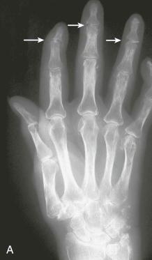 FIGURE 54–1, Mixture of features of atypical rheumatoid arthritis and systemic scleroderma. A , Anteroposterior view of the hand shows periarticular demineralization. Soft tissue loss of the tip of the index finger, soft tissue calcification, and bandlike destruction of the distal interphalangeal joints (arrows) resemble the features of scleroderma. Carpal involvement and soft tissue swelling due to tenosynovitis of the extensor carpi ulnaris are similar to the findings in rheumatoid arthritis.