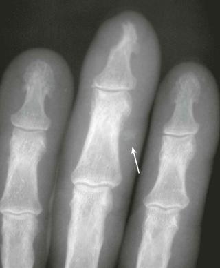FIGURE 54–2, Features of systemic scleroderma in mixed connective tissue disease: tuftal resorption and faint soft tissue calcification (arrow) in a patient with mixed connective tissue disease with sclerodactyly.