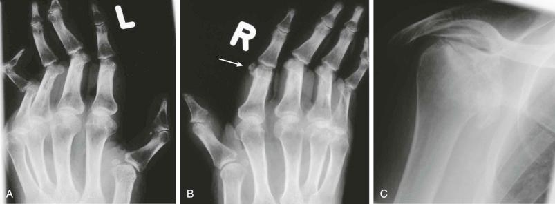 eFIGURE 54–1, Mixture of systemic lupus erythematosus and systemic sclerodermal features. A and B , Nonerosive deforming arthropathy affects the small joints, especially the proximal interphalangeal joints with swan neck deformity and the metacarpophalangeal joints with flexion deformity. Marked periarticular demineralization is present. A single spot of soft tissue calcification is located at the right index finger (arrow) . C , Mixed connective tissue disease with avascular necrosis of the humeral head with a large defect and considerable secondary deformation of the glenoid.