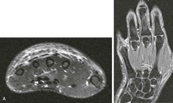 eFIGURE 54–2, A , Transverse proton density, fat saturation, turbo spin-echo image—nonspecific findings of soft tissue swelling and extensor tenosynovitis in a patient with puffy hands at the initial diagnosis. B , No erosions of the carpus or metacarpophalangeal joints are found (coronal contrast-enhanced T1-weighted fat-suppressed).