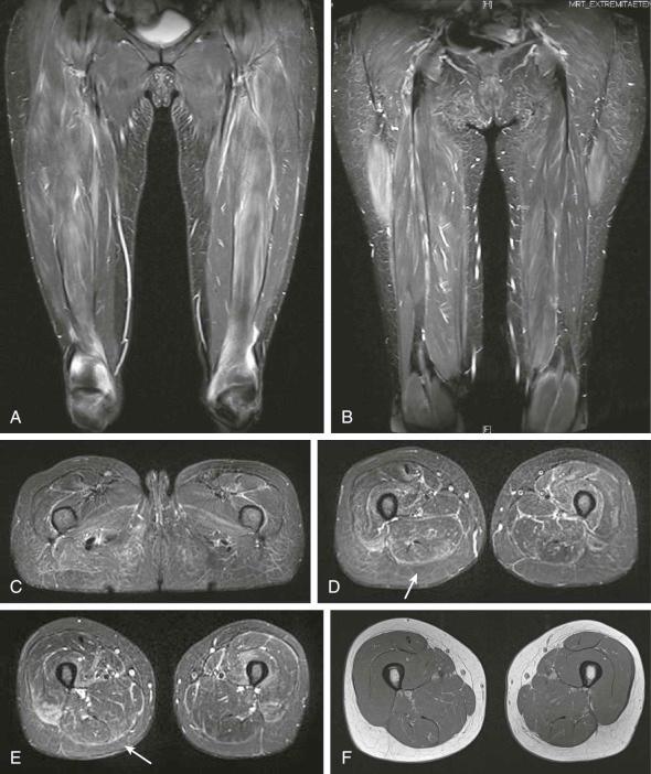 eFIGURE 54–3, A 48-year-old woman, 2 years disease duration with symptoms of polymyositis and elevated levels of creatine kinase MM and aldolase. Short tau inversion recovery (STIR) images show edema-like signal abnormalities of the quadriceps muscles of both sides, and the adductor and the biceps femoris on the right side ( A , B , and C respectively, coronal and transverse respectively, STIR). Areas of myofascial pattern are displayed ( arrows in D and E , transverse STIR images). No muscle atrophy is present. F , T1 weighted transversal.