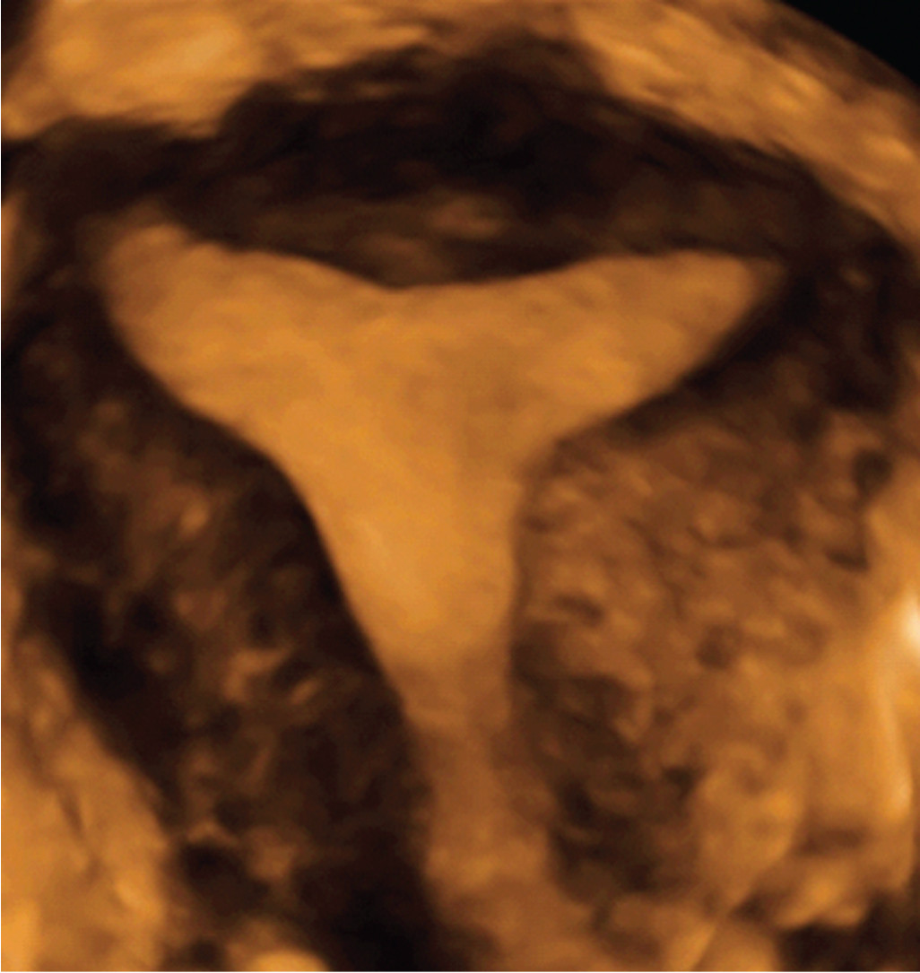 Fig. 35.1, Three-dimensional (3D) ultrasound of a normal uterus. With a 3D volume acquisition scan of the uterus, the external contour of the uterus can be assessed in addition to the configuration of the uterine cavity. This may be helpful in differentiating the various Müllerian anomalies.