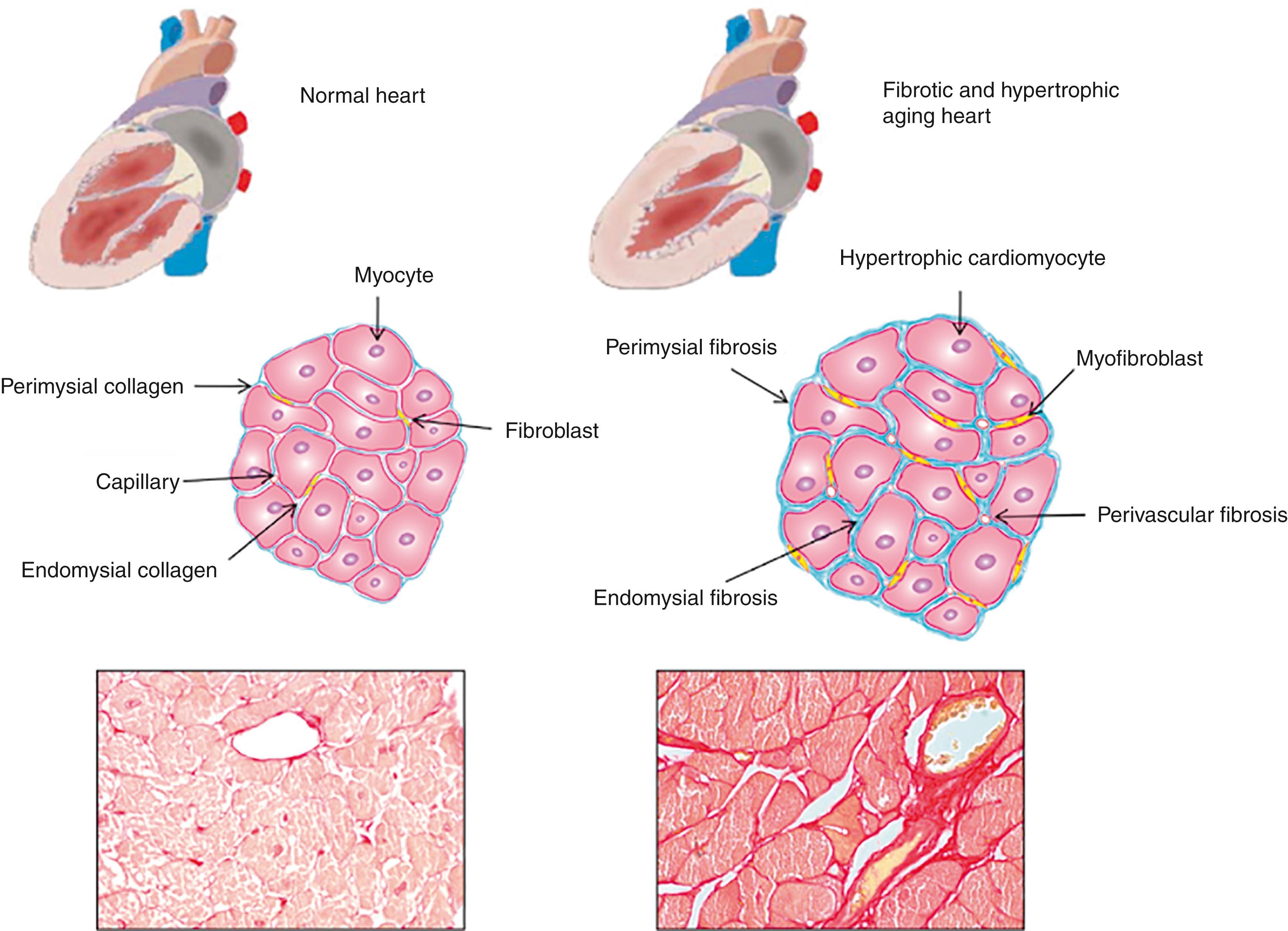 Fig. 36.1, Age-dependent remodeling of the human heart highlighted by a schematic comparison of normal (left) and senescent (right) properties of organ size/shape (top row) and cardiac tissue properties (middle row) . Histopathologic images (bottom row) show remodeled tissue in C57BL/6 mice of different ages (left, 2 months old; right, 2 years old). Red-stained regions indicate collagenous tissue.