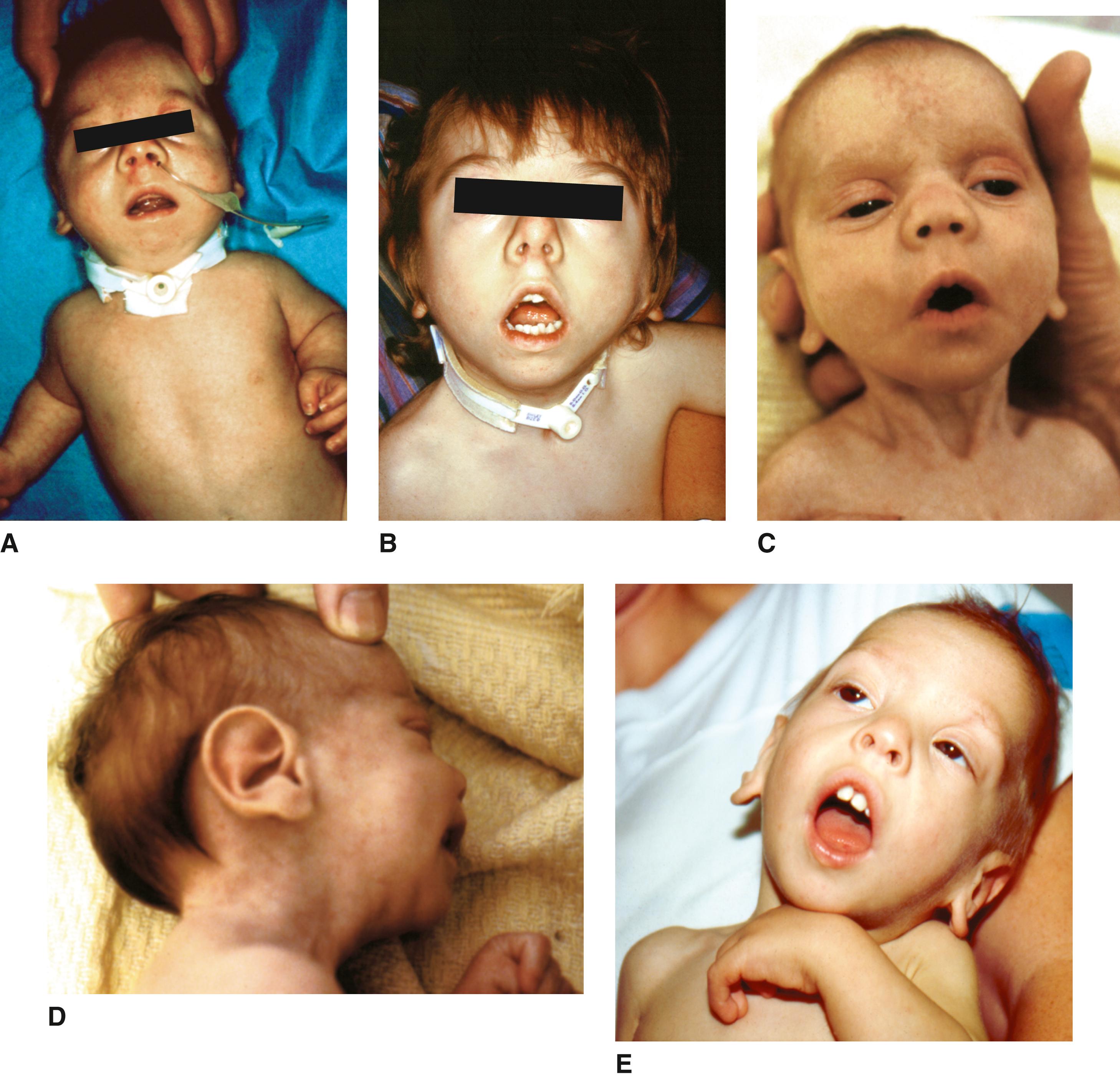 FIGURE 1, Smith-Lemli-Opitz syndrome.