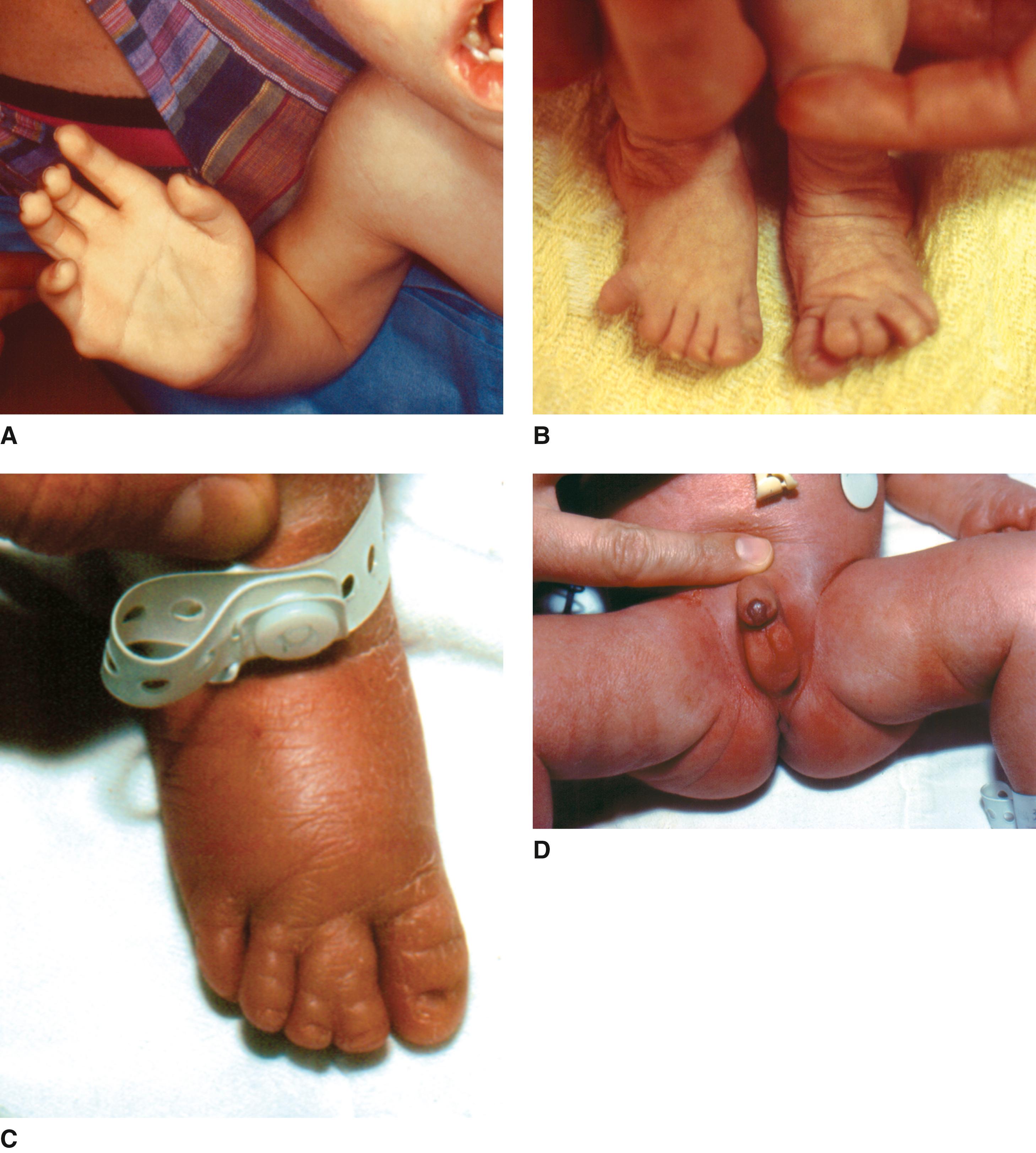 FIGURE 2, A–D, Note the polydactyly, camptodactyly, 2-3 syndactyly of the toes, and hypospadias.