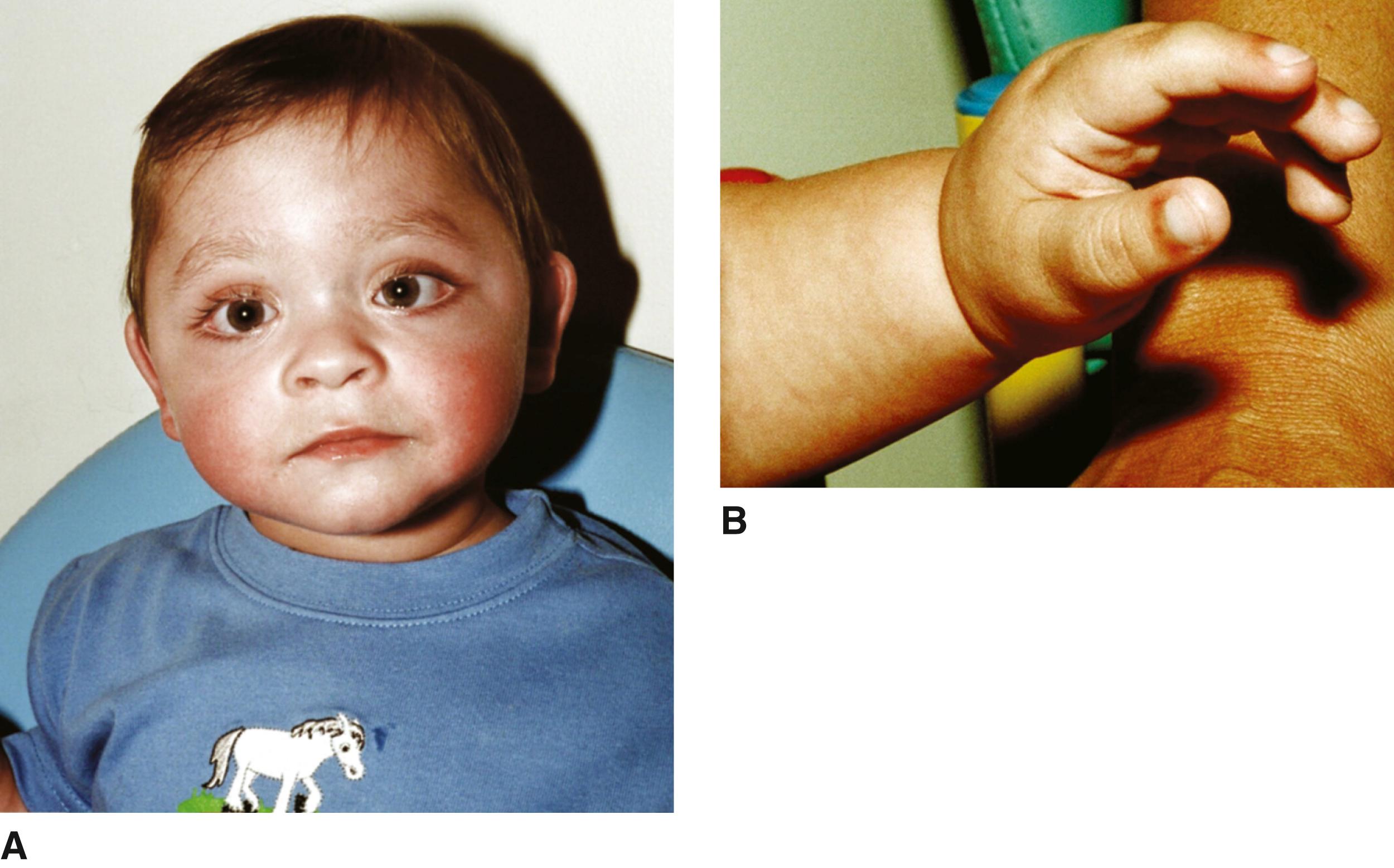 FIGURE 1, Kabuki syndrome.