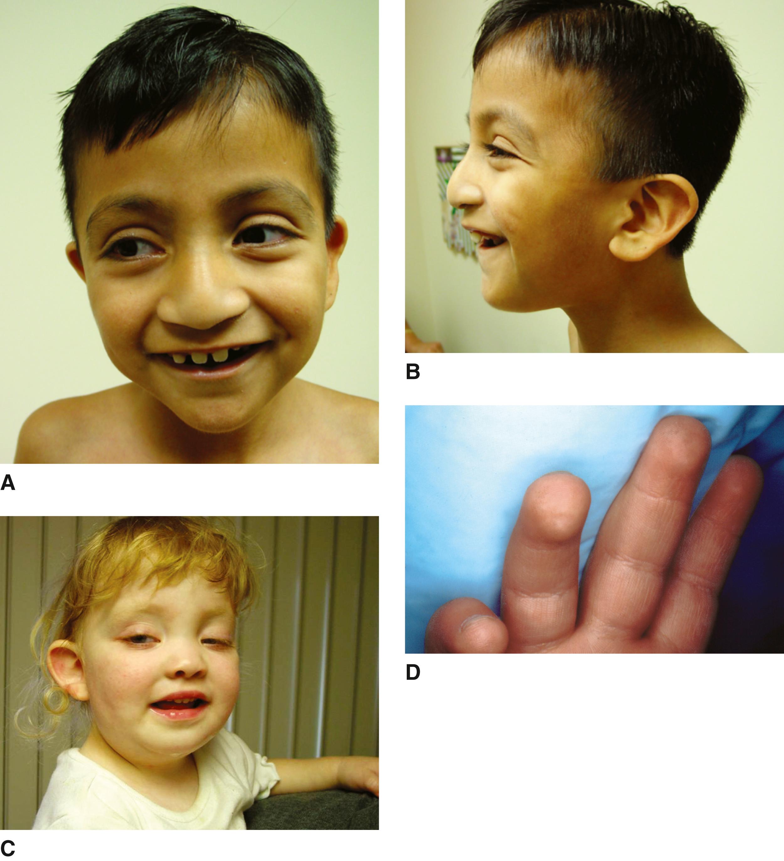 FIGURE 2, A–D, A 3-year-old boy and 4-year-old girl. Note the long palpebral fissures, large protruding ears, and prominent fingertip pads.