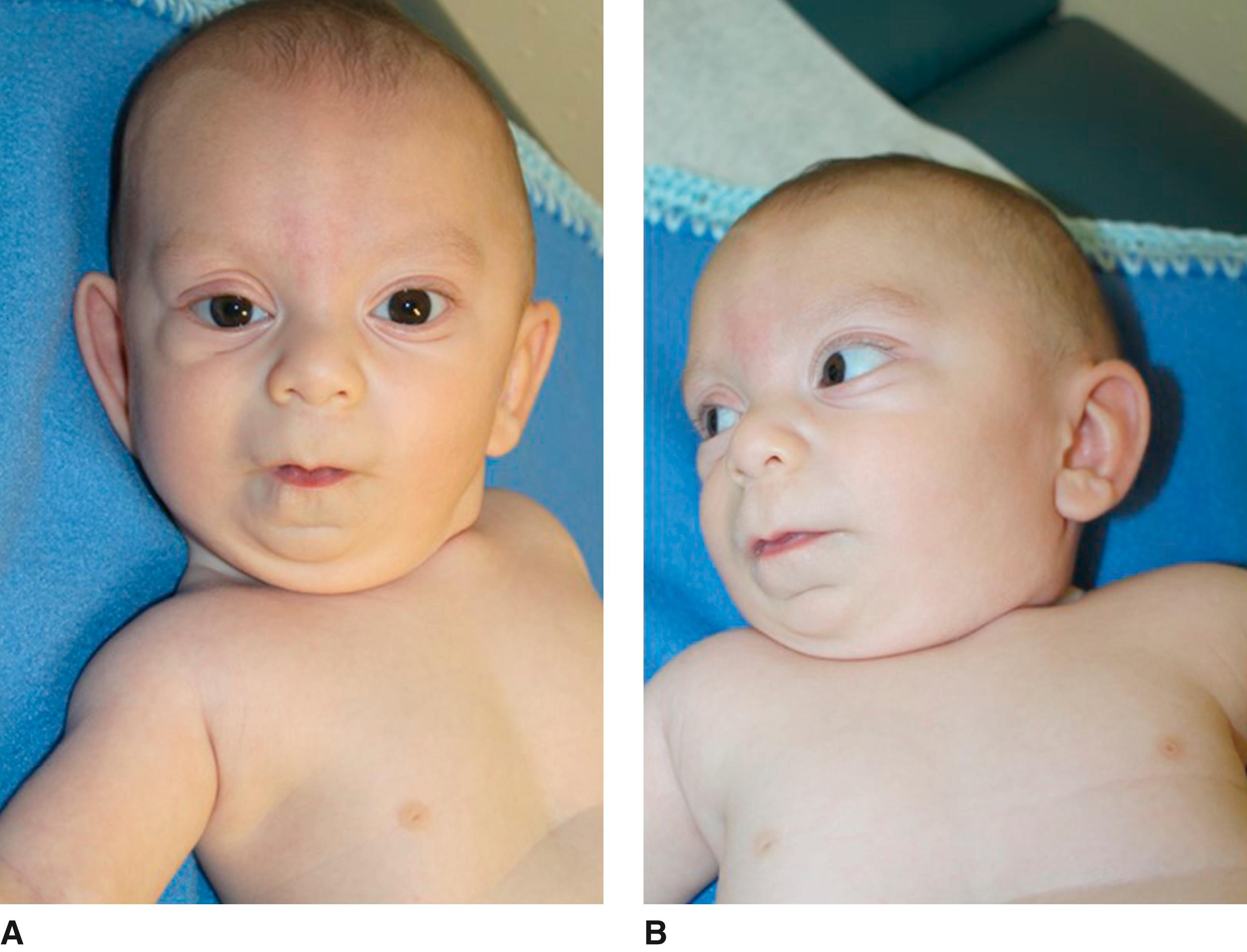 FIGURE 1, In this 6-month-old boy, note mildly coarse facies, striking supra- and infraorbital creases, sparse hair and eyebrows, large ears with ear lobe creases, and excess nuchal skin .