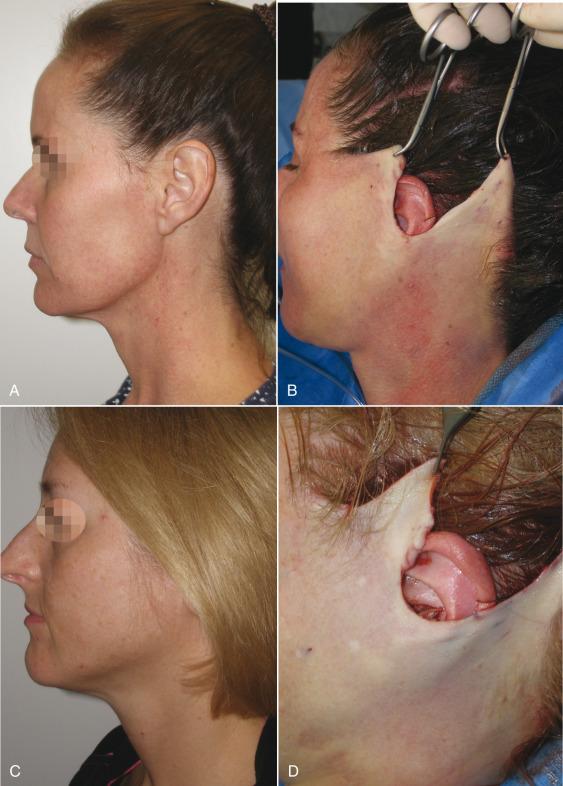 Fig. 8.1, Both of these patients requested a “weekend” (short scar) facelift. Observing these before picture (A, C) shows that both patients appeared to have only minor skin excess. The intraoperative pictures of both patients show the amount of skin excess that actually existed (B, D). This impressive amount of skin required conversion to a conventional facelift, otherwise the patient would have not had an optimum result and longevity.