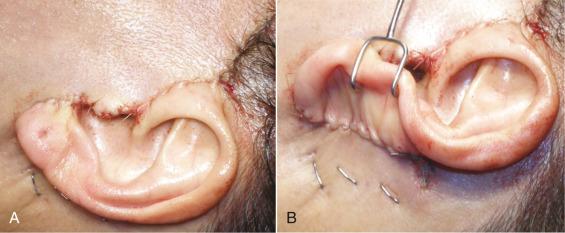 Fig. 8.17, The anterior incisions are closed with 5-0 gut suture (A) and the posterior incision is closed with 4-0 gut suture (B).